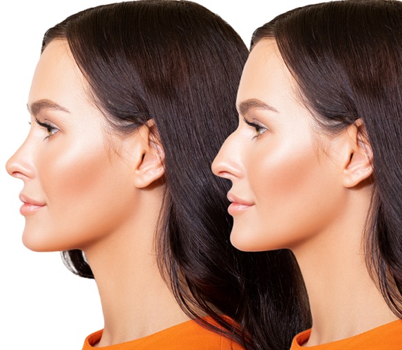 عمليات تجميل الأنف